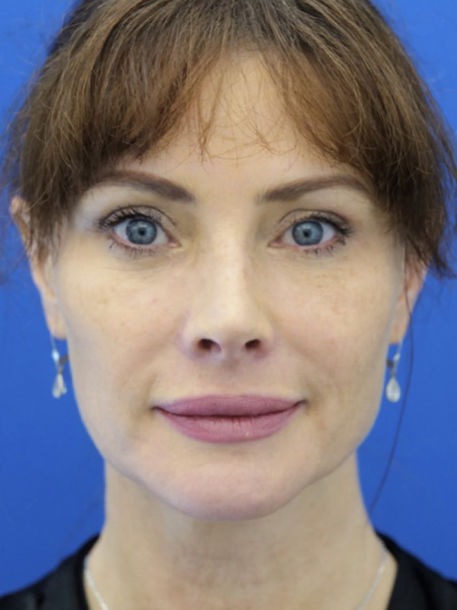 Case 7252: after Lower Lid Fat Reposition