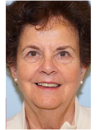Visual Field Deficit – Eyelid Excess Skin1* — After