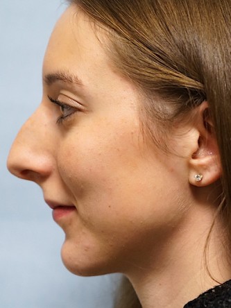 Nasal Hump Endonasal Rhinoplasty* — Before