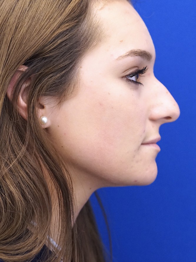 Endonasal Profile — Before