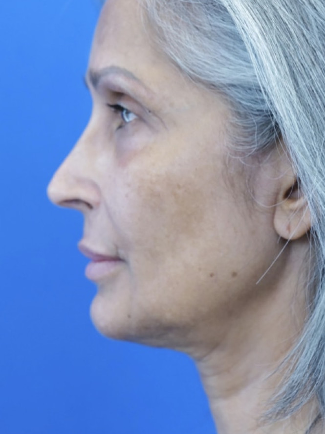 Face and Endobrow Lift — Before