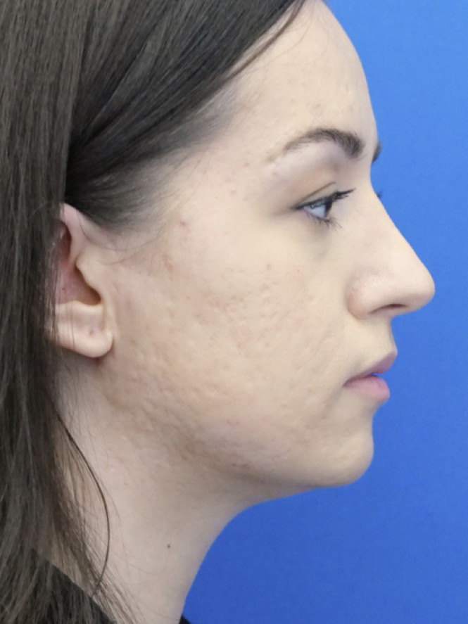 Dorsal Hump Removal — After