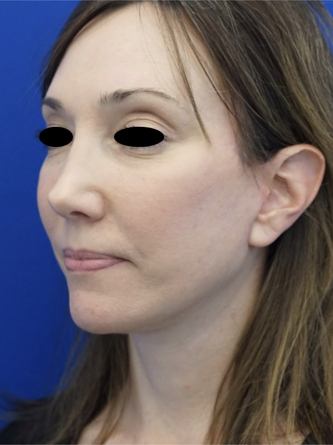 Secondary Deep Plane Lift with Scar Revision — After