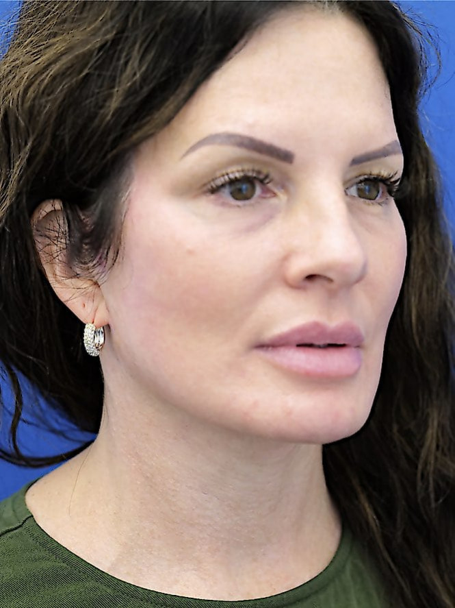 Deep Plane Cheek and Facelift — After