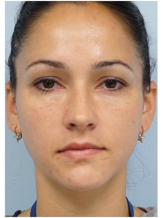 Restylane Silk to Tear Trough – Under Eye* — After