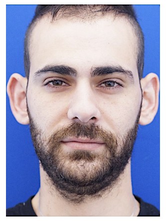 Prominent Ears — Before