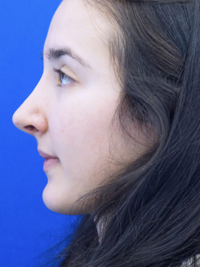 Endonasal Finesse Rhinoplasty — After