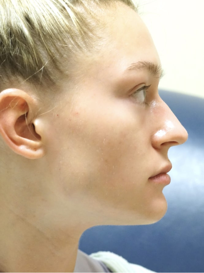 Nasal Profile Plasty — Before