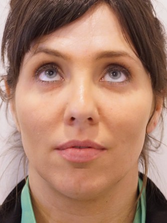 Under Eye Shadow* — Before