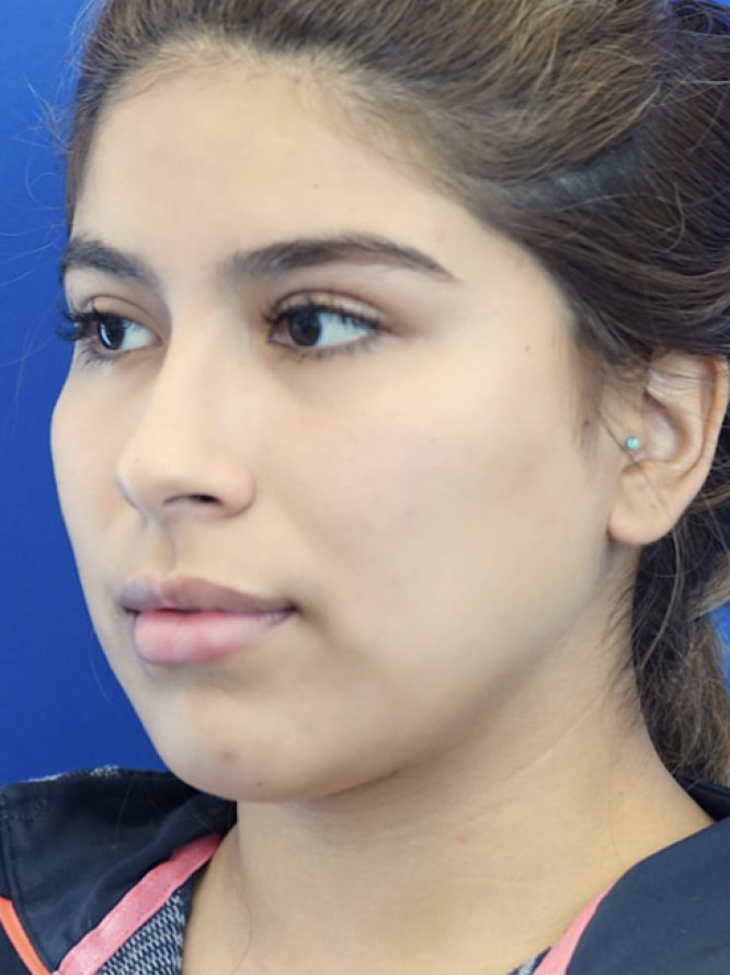 Cheek Contouring — Before