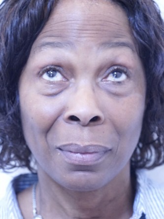 Tear Trough Under Eye Enhancement — Before