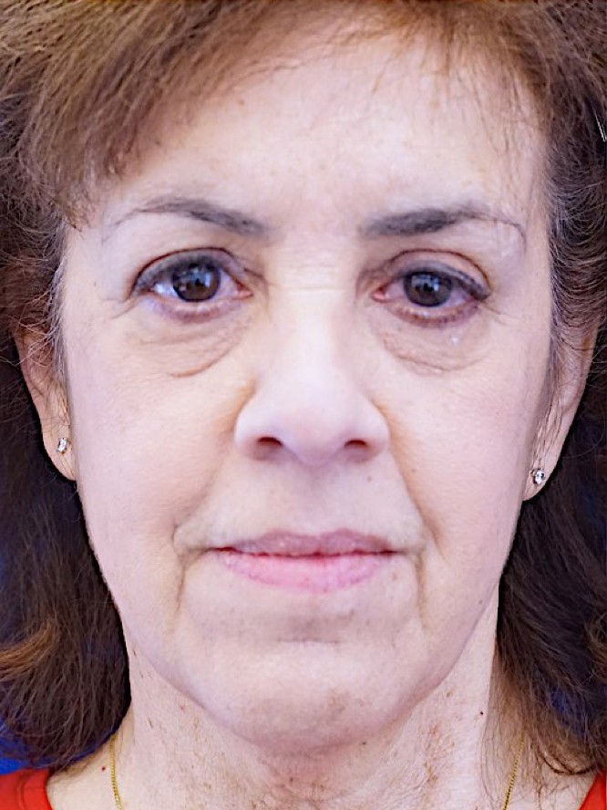Festoon and Left Ptosis Repair — Before