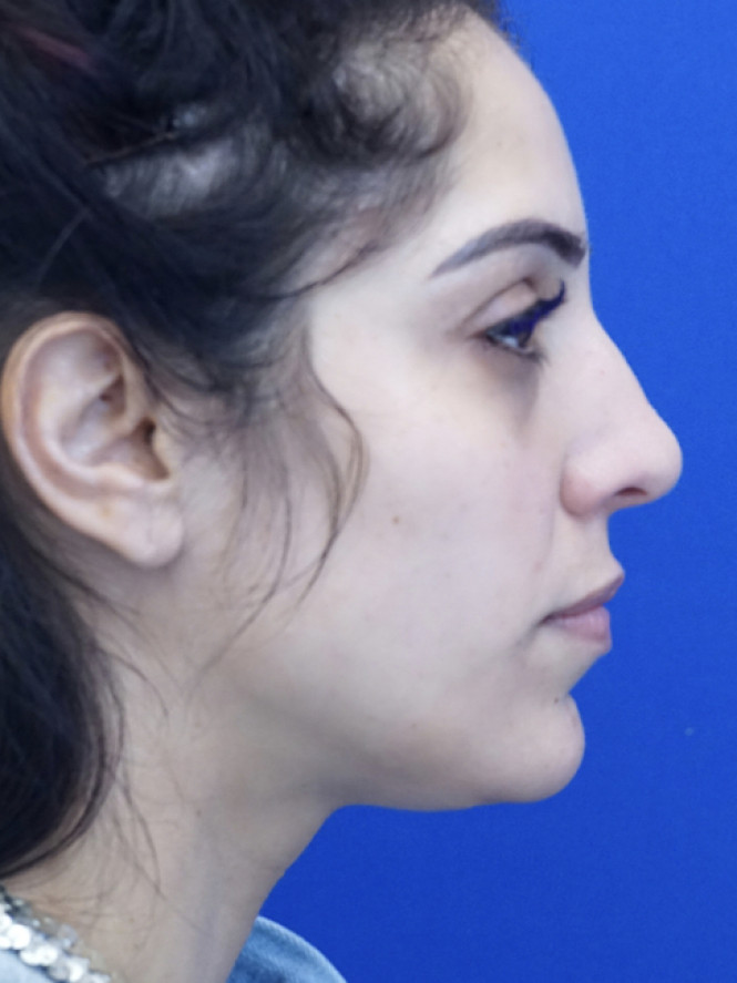 Dorsal Hump and Thick Skin — Before