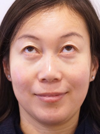 Restylane Silk to Dark Circle* — Before