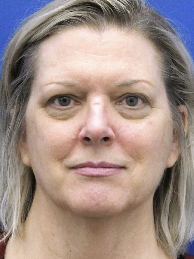Case 6655: before Endoscopic Browlift, Quad Blepharoplasty