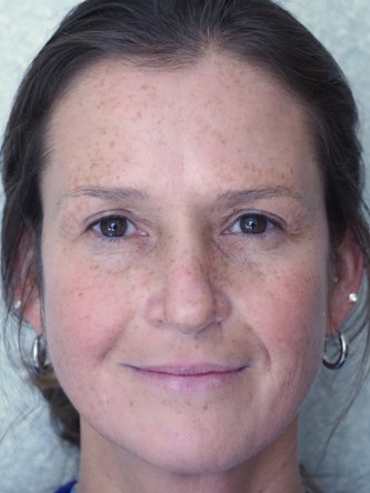 Excess Upper Eyelid Skin* — After