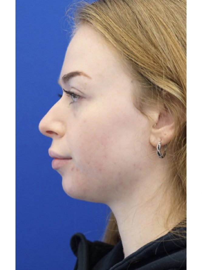 Elegant Nasal and Chin Profile — Before