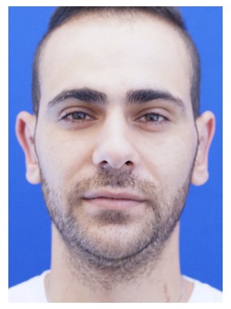 Prominent Ears — After