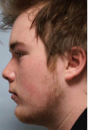 Crooked Nose Endonasal Technique3* — After