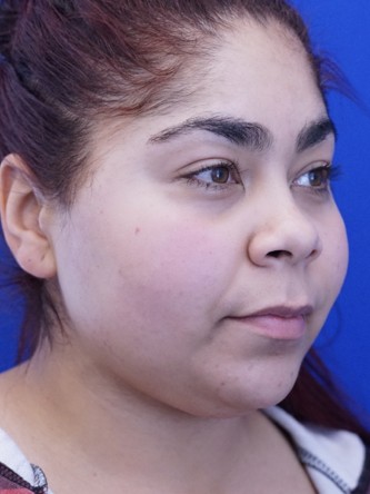 Restylane Silk Balances Lip Fullness* — Before