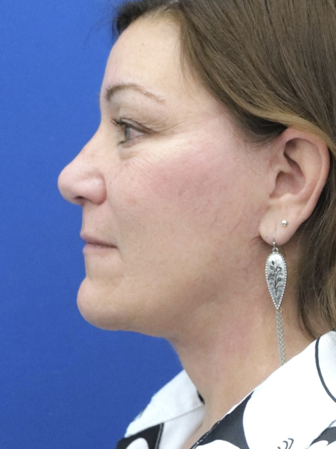 Full Upper and Lower Facelift — After