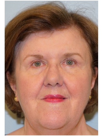 Upper Eyelid Skin Excess2* — After