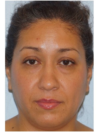 Lower Eyelid Excess Fat Pad3* — Before