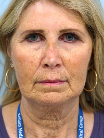 Endoscopic Browlift, Facial Fat Graft, Full Facelift, Fractional CO2 Laser* — Before
