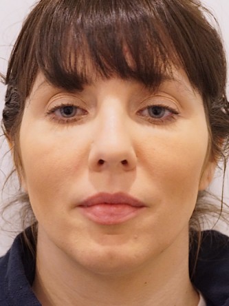 Under Eye Shadow* — After
