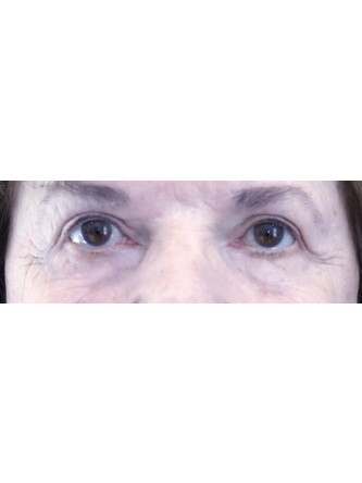 Lower Blepharoplasty with Canthopexy — Before