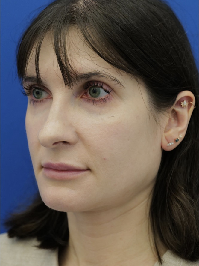 Preserving Tip Surface Aesthetics — Before