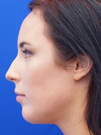 Chin Implant and Upper Lip Filler* — After