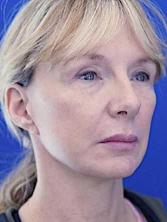 Upper Eyelid Lift* — After
