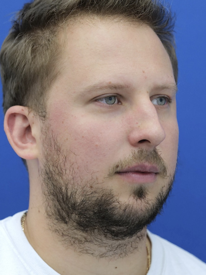 Dorsal Hump and Chin Augmentation — Before