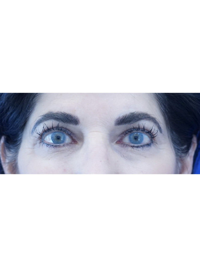 Eyelid Crease Refreshening — After