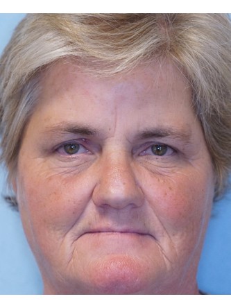 Brow Droop & Upper Eyelid Skin Excess* — After