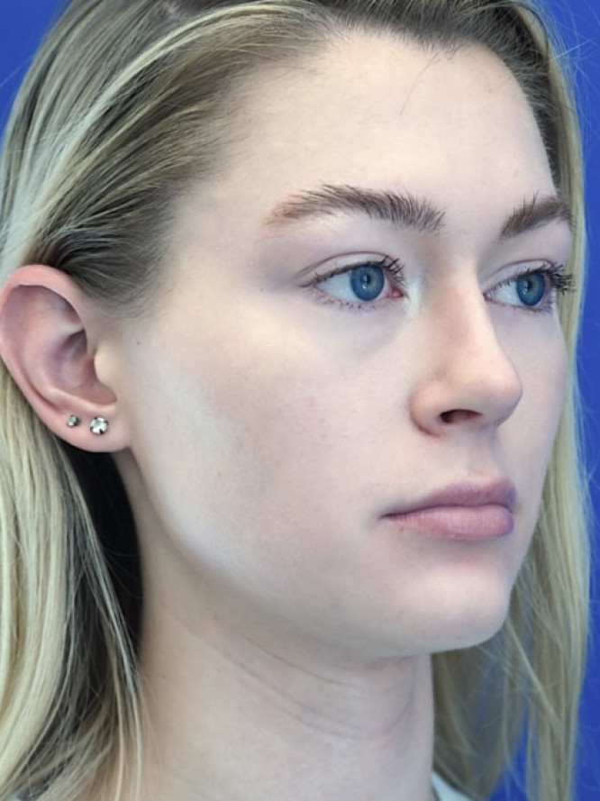 Nasal Profile Plasty — After
