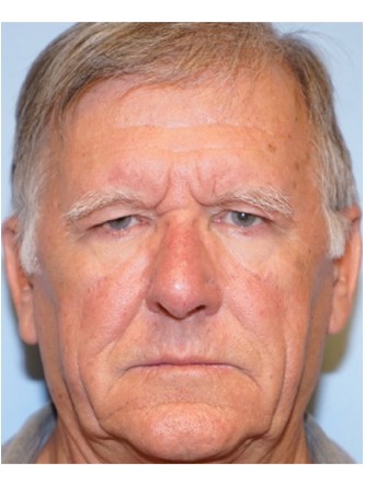 Endoscopic Browlift2* — Before