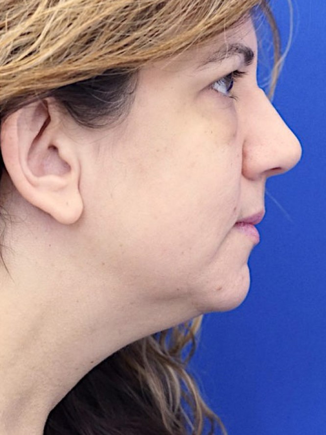 Deep Plane Face Lifting — Before