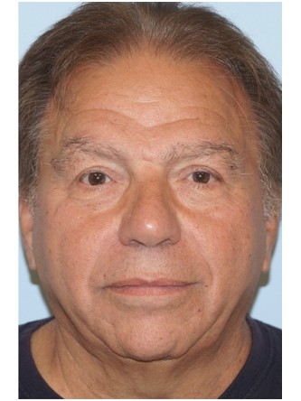 Visual Field Deficit – Eyelid Ptosis2* — After