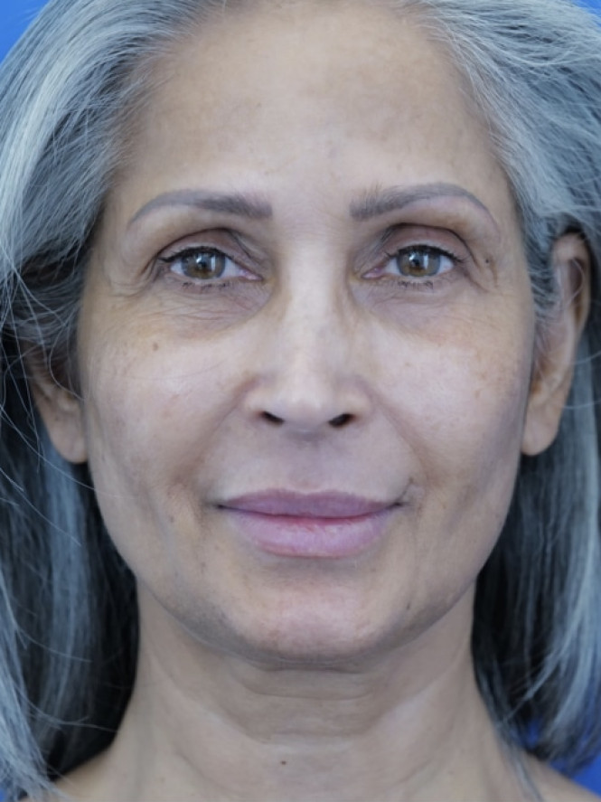 Face and Endobrow Lift — Before
