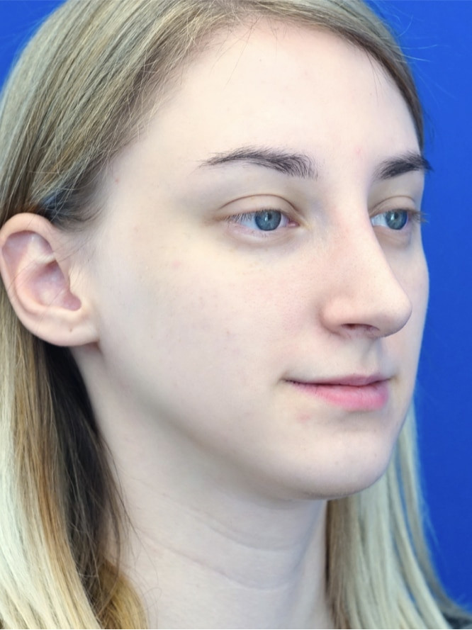 Dorsal Hump and Tension Tip — After