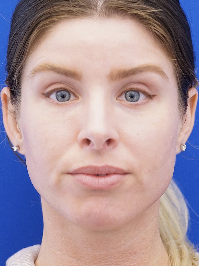 Lower Eyelid Skin Laxity — After