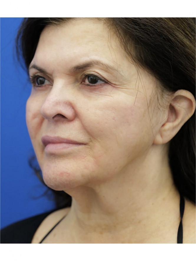 Lower Facelift Chin Reduction — Before