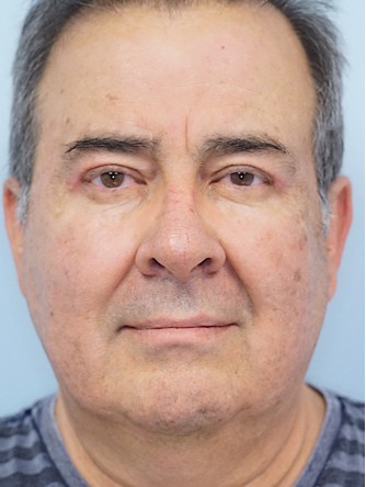 Blepharoplasty Ptosis Repair* — After