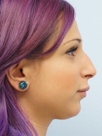 Juvederm Upper and Lower Lip Fillers* — After