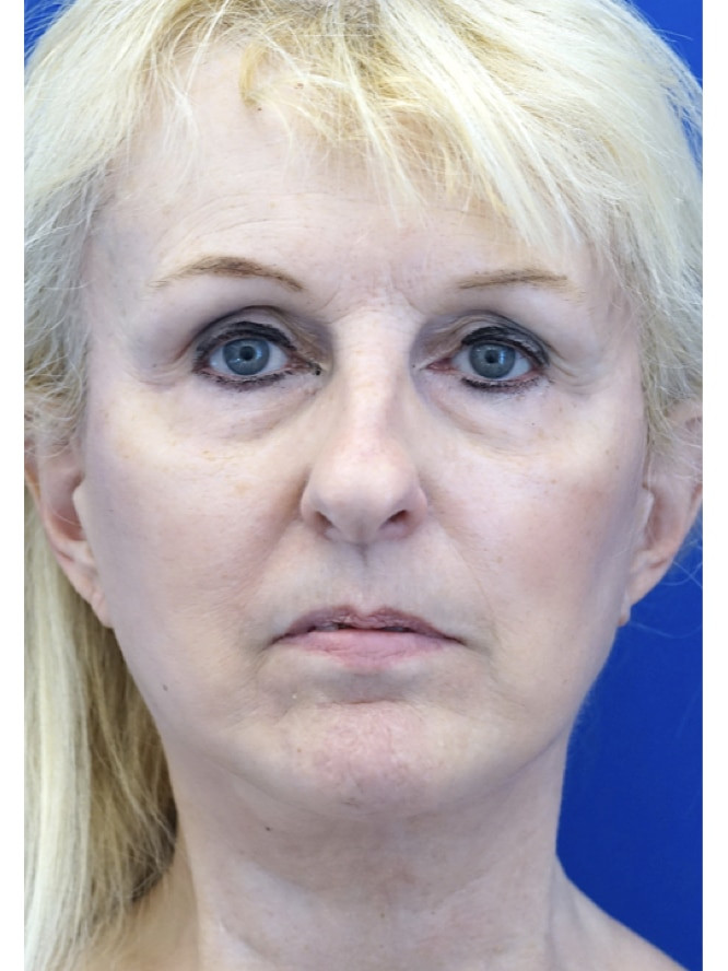 Subciliary Blepharoplasty Fat Reposition — Before