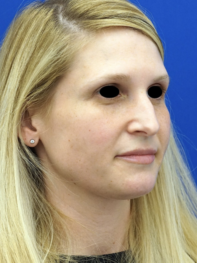 Scarless Hump Removal — Before