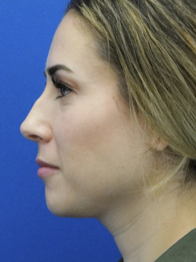 Mild Hump Reduction — Before