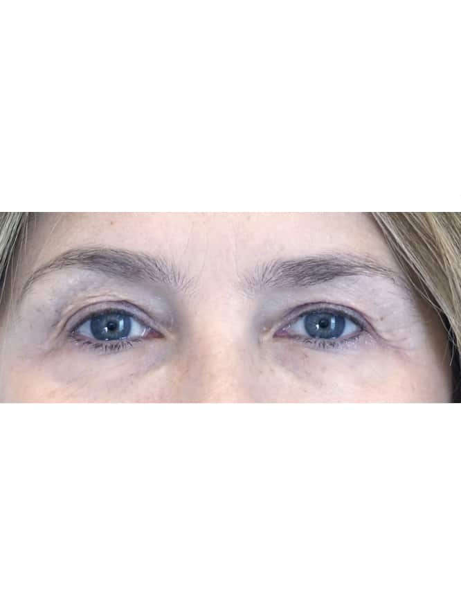 Cosmetic Upper Eyelid Surgery — Before